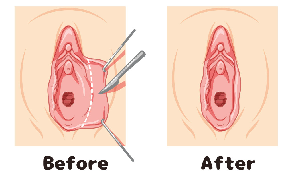 Taking Before And After Photos Private Parts